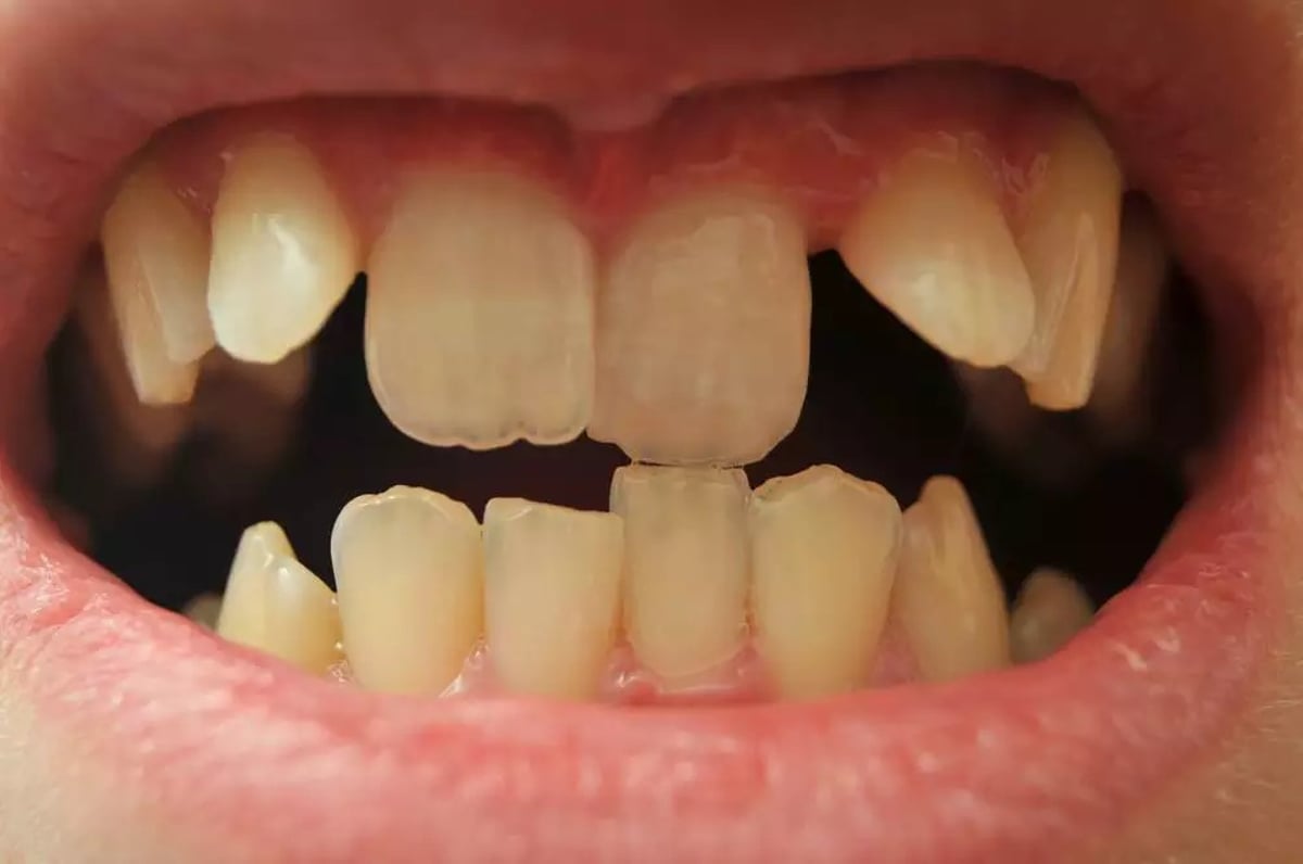 Imagem da publicação original: As causas de dentes tortos e a importância do tratamento ortodôntico