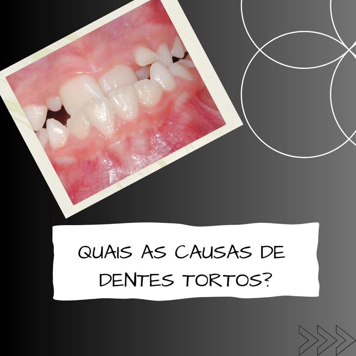 Imagem da publicação original: Quais são as causas de dentes tortos?